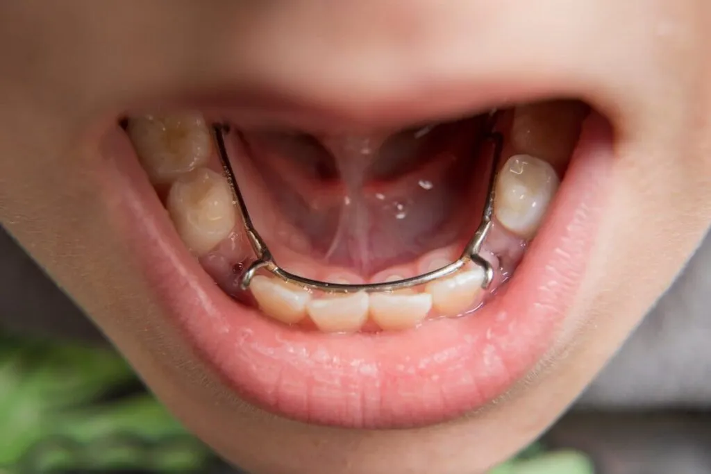 young boy having a dental space maintainer in his mouth