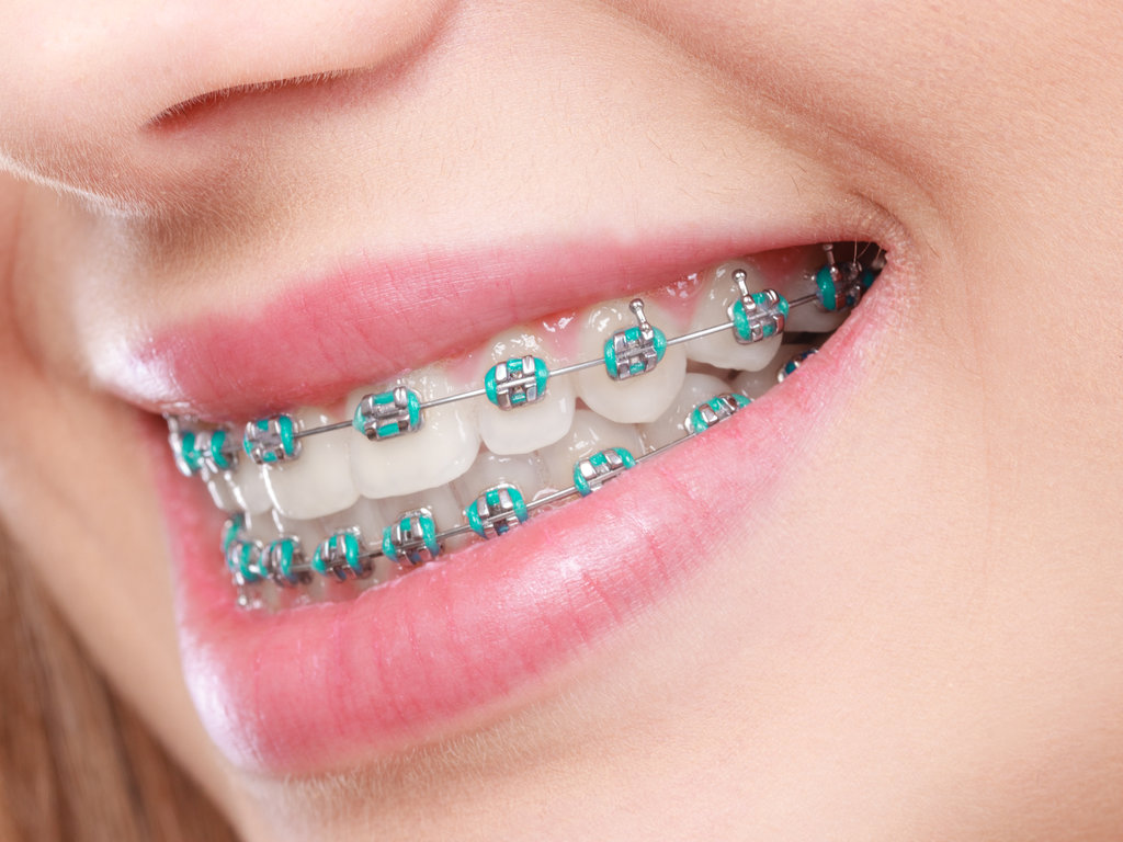 Dentist and orthodontist concept. Closeup of woman smile showing teeth with blue braces