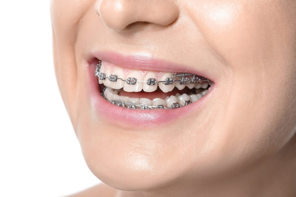 Adult patient smiling confidently during an orthodontic consultation for braces or clear aligners
